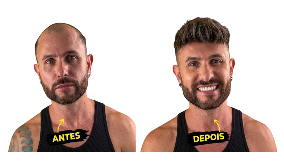 Antes e depois de um trabalho de prótese capilar